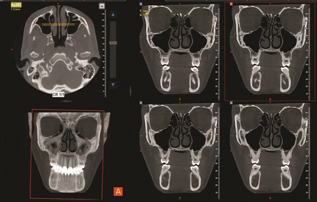 Rappresentazione 3D CBCT