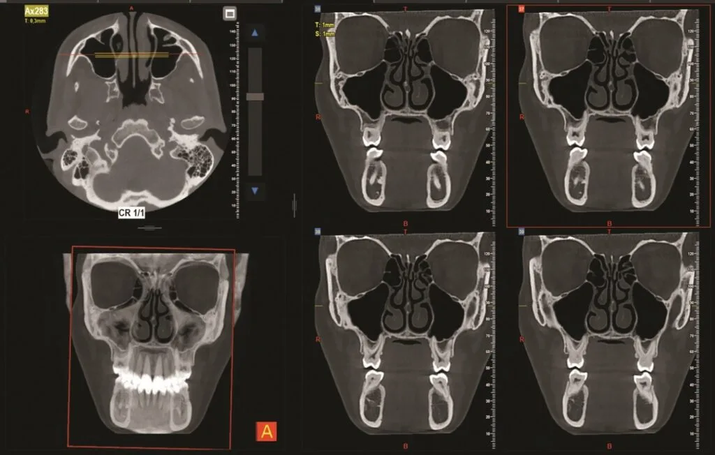 CBCT snímky prinosových dutín v priečnom a čelnom reze